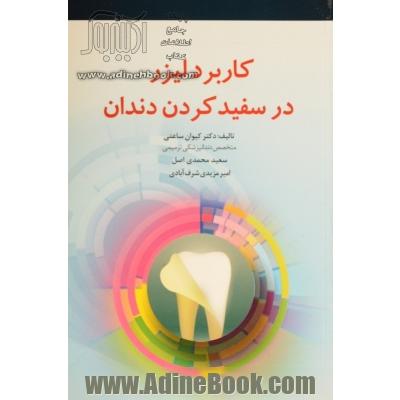 کاربرد لیزر در سفید کردن دندان